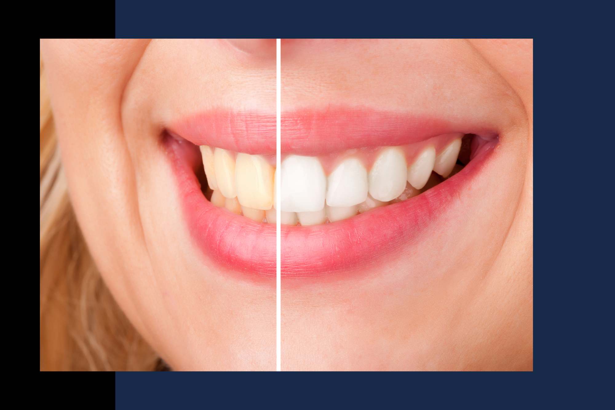 Teeth Whitening Duncan SC