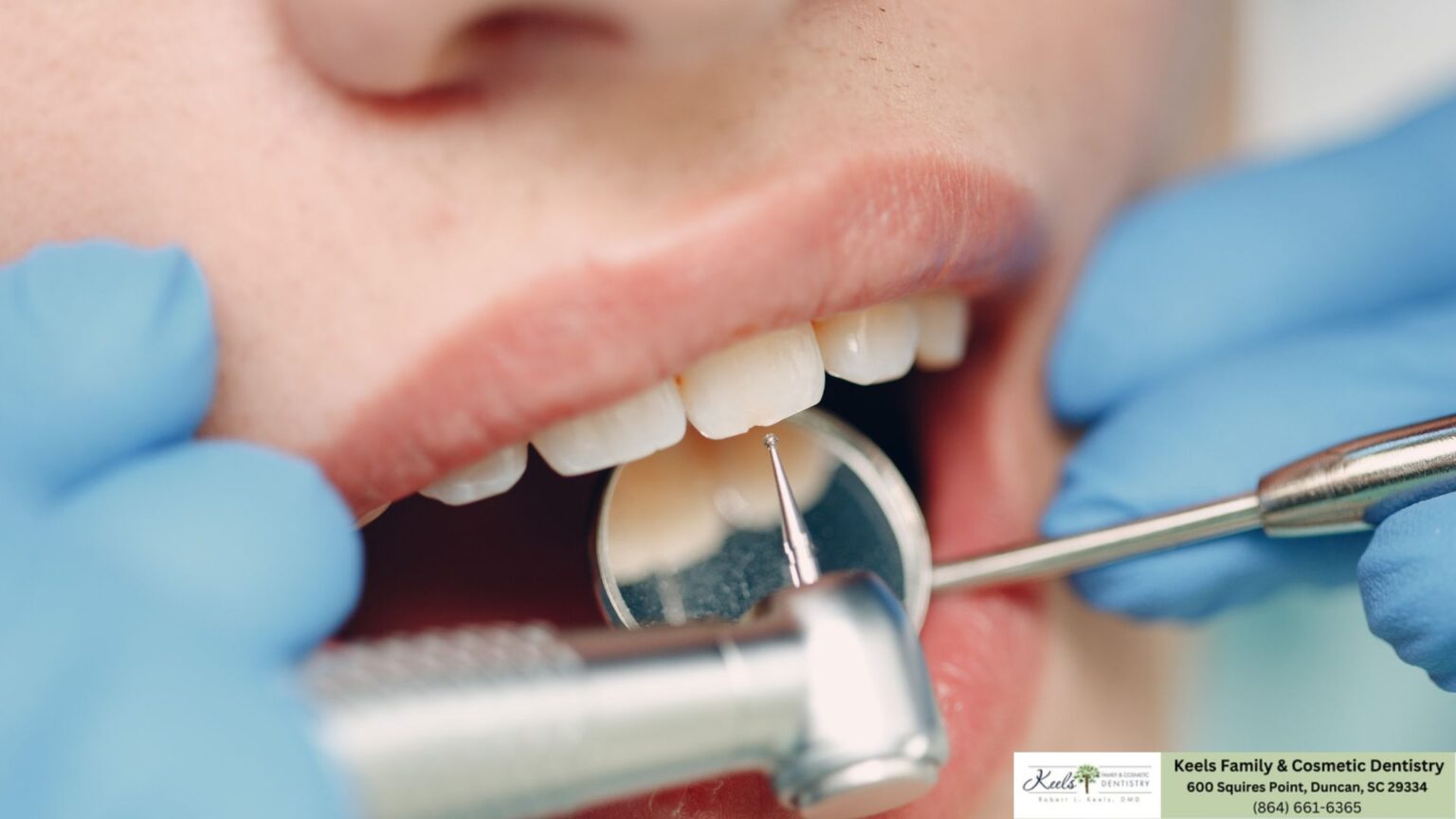 3 Types of Teeth Cleanings Keels Family