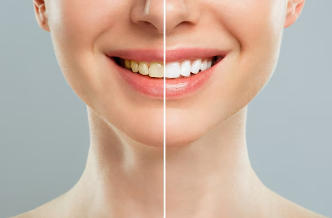 Teeth Whitening - Keels Family Dentistry