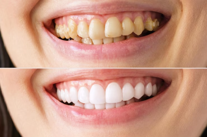 Teeth Whitening at Keels