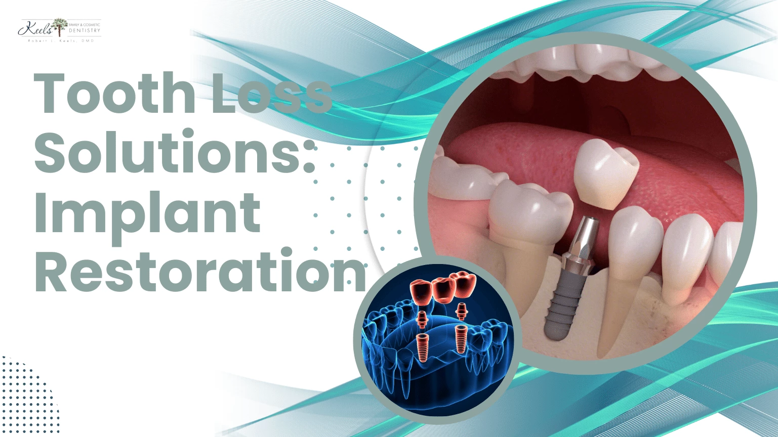 Tooth Solutions Implant Restoration