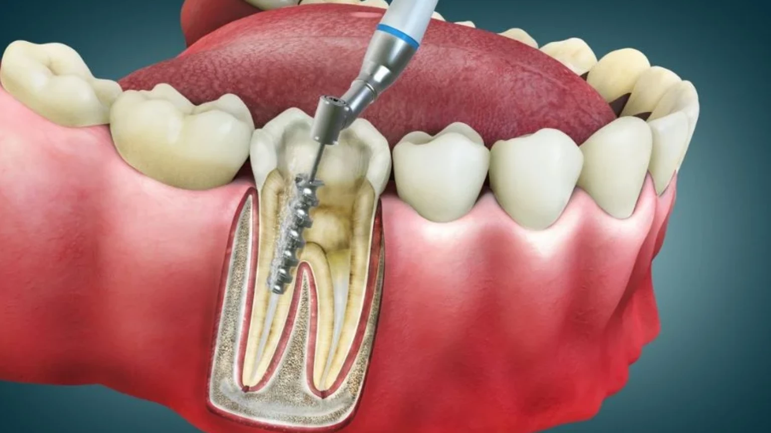 Managing Back Tooth Pain through Root Canal Therapy